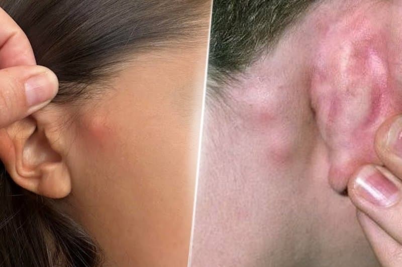 Tình trạng sưng hạch khu trú xảy ra ở nhóm hạch nhỏ khi vùng lân cận bị tổn thương