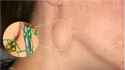 Nổi hạch lâu năm không đau cần làm gì? Giải đáp chi tiết