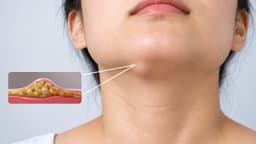 Nổi u mỡ dưới cằm? Triệu chứng và chẩn đoán