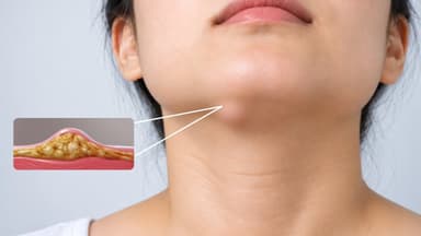 Nổi u mỡ dưới cằm? Triệu chứng và chẩn đoán