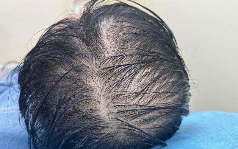 Rụng tóc do viêm gan B cần phân biệt với các nguyên nhân khác