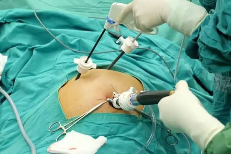 Mổ nội soi sỏi mật là phẫu thuật nội soi để điều trị sỏi gây bệnh ở túi mật, về chuyên môn thường gọi là cắt túi mật nội soi