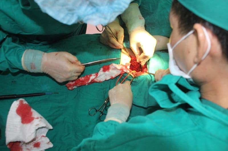 Mổ nội soi sỏi mật có thể phải chuyển sang mổ hở nếu phẫu trường không thuận lợi