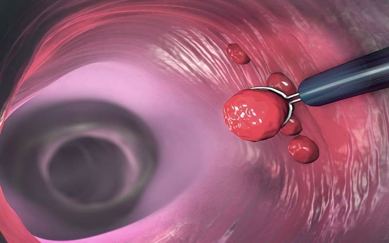 Phần lớn polyp lành tính, nhưng một số loại có thể tiến triển thành ung thư nếu không được theo dõi, xử lý phù hợp.