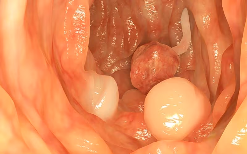 Polyp là những khối mô tăng sinh bất thường, xuất hiện ở nhiều cơ quan trong cơ thể