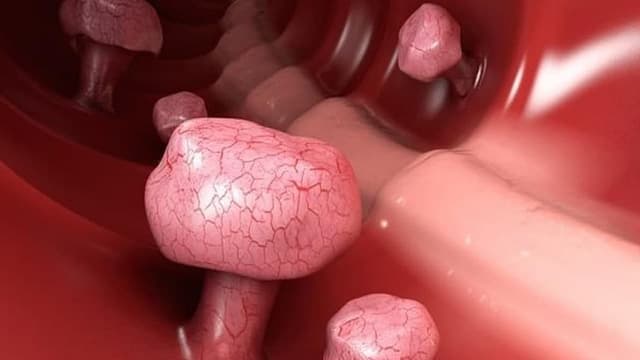 Polyp là gì? Polyp có phải ung thư không?