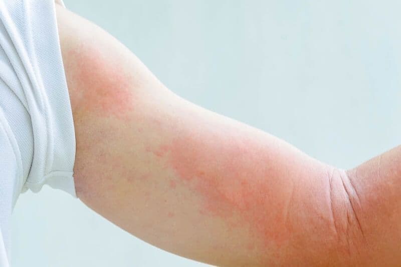 Không phải bệnh gan nào cũng gây ngứa da