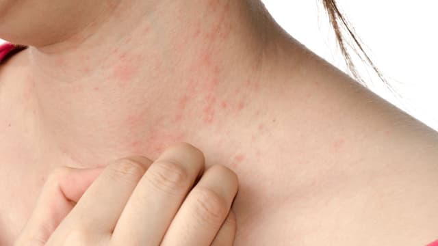 Sẩn ngứa do gan: Nguyên nhân, dấu hiệu nhận biết và cách xử lý