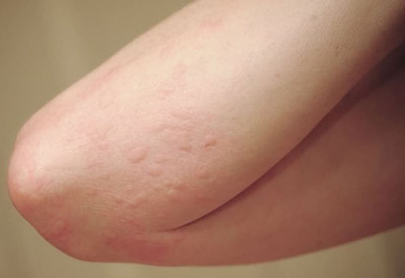 Sẩn ngứa do gan là tình trạng da xuất hiện các nốt sẩn hoặc vùng da ngứa ngáy, có thể liên quan đến bệnh lý ở gan hoặc đường mật