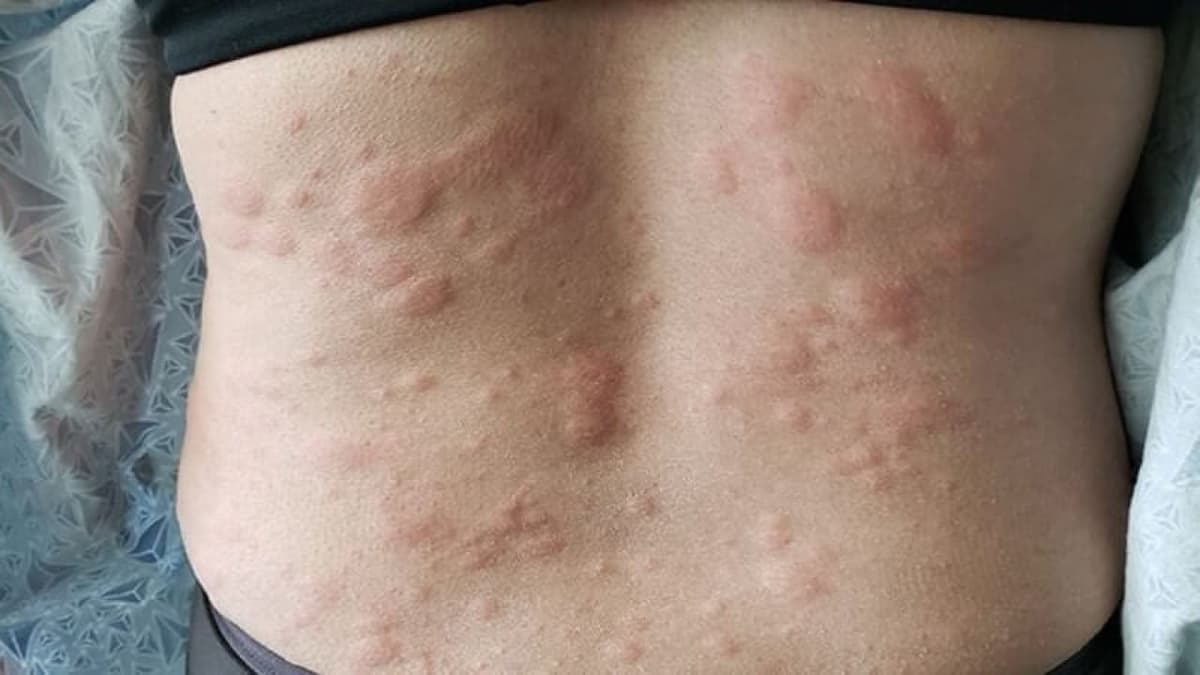 Sẩn ngứa do gan? Nguyên nhân và khi nào cần đi khám để điều trị?