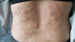 Sẩn ngứa do gan? Nguyên nhân và khi nào cần đi khám để điều trị?