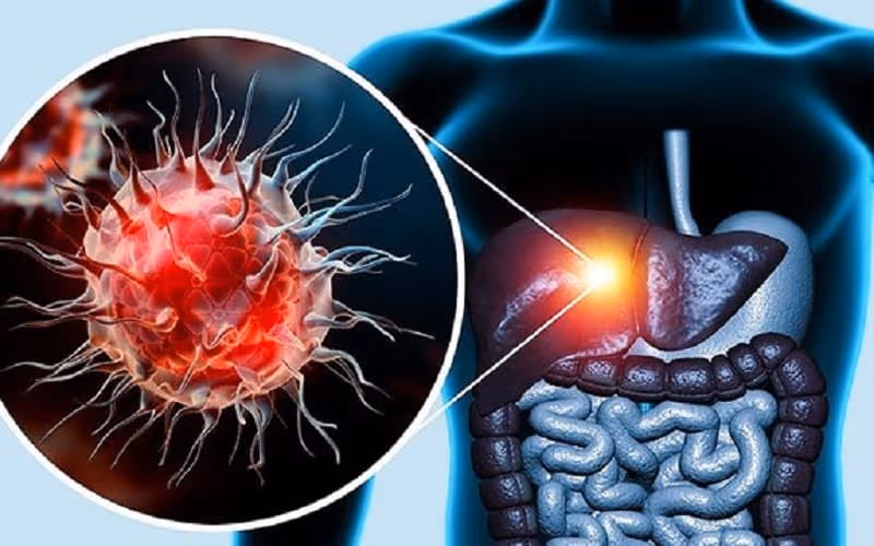 Biến chứng sau nút mạch gan có thể gây nhiễm trùng và tổn thương gan