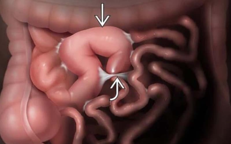 Tắc ruột cao xảy ra ở phần đầu của ống tiêu hóa