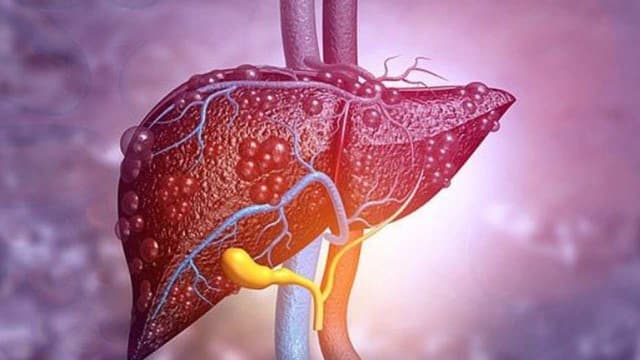 Teo gan có nguy hiểm không? Nguyên nhân, dấu hiệu và hướng điều trị