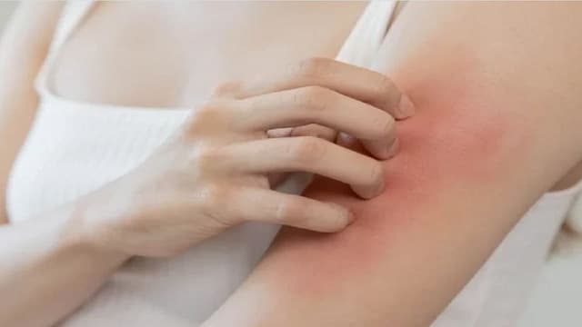 Thuốc dị ứng là gì và chọn loại nào an toàn, hiệu quả nhất?