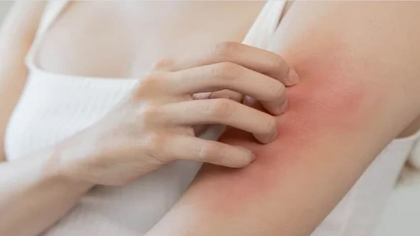 Thuốc dị ứng là gì và chọn loại nào an toàn, hiệu quả nhất?