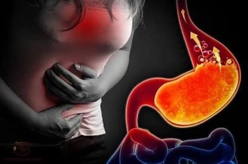 Trào dịch dạ dày là tình trạng dịch tiêu hóa từ dạ dày trào ngược lên thực quản
