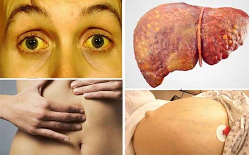 Triệu chứng ung thư gan giai đoạn cuối