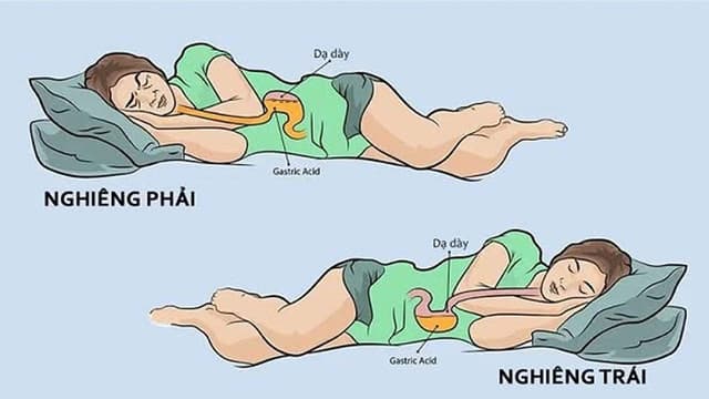 Đâu là tư thế nằm tốt cho dạ dày mà bác sĩ khuyên sử dụng?