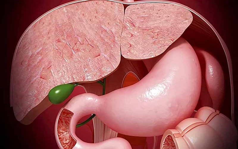 Sỏi mật vẫn có thể tạo ra hiện tượng túi mật to không đau nếu viên sỏi kẹt ở ống túi mật