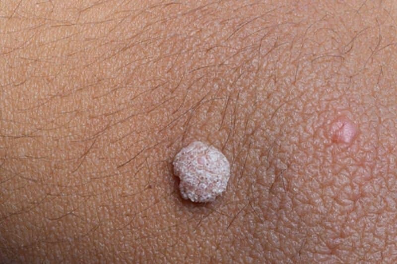 U nhú thường xuất hiện trên da, ống tuyến vú hoặc niêm mạc do nhiễm vi-rút HPV