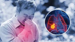U phổi ác tính sống được bao lâu? Giải đáp yếu tố ảnh hưởng