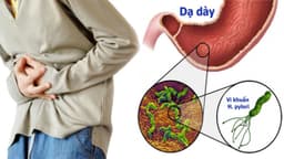 Vi khuẩn dạ dày là gì? Những điều cần biết về vi khuẩn H. pylori ở dạ dày