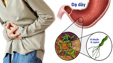 Vi khuẩn dạ dày là gì? Những điều cần biết về vi khuẩn H. pylori ở dạ dày