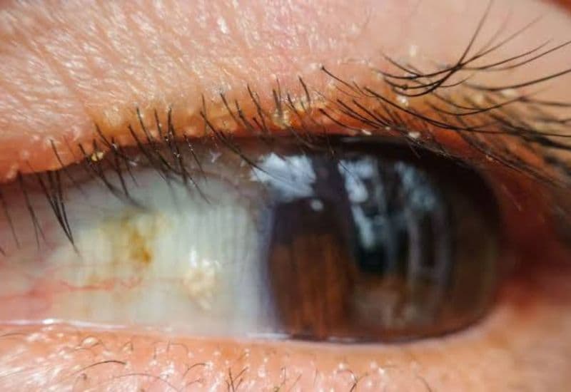 viêm bờ mi do Demodex