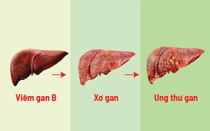 Viêm gan mạn tính có thể tiến triển thành xơ gan