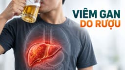 Dấu hiệu và cách điều trị viêm gan do rượu