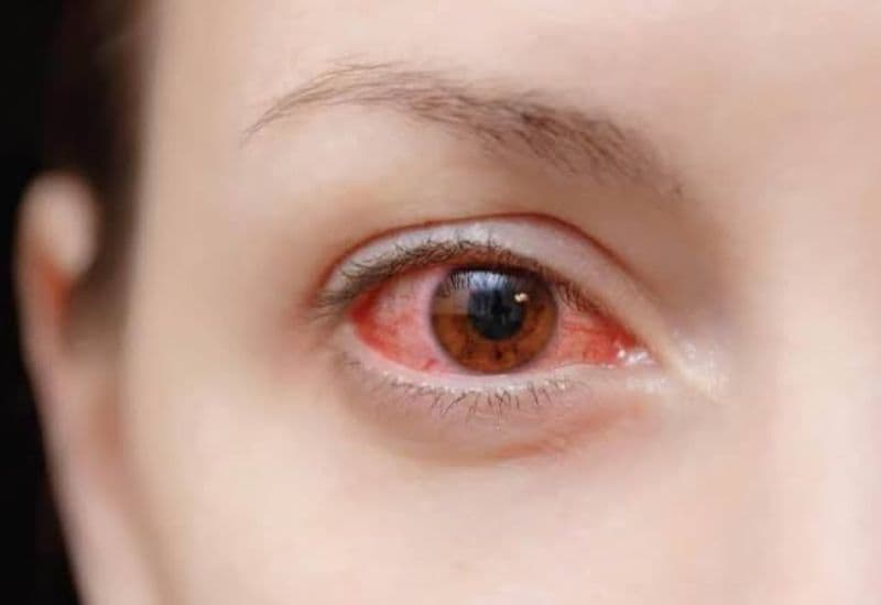 viêm giác mạc chấm nông
