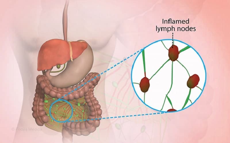 Viêm hạch mạc treo gây sưng viêm các hạch bạch huyết ở vùng mạc treo, thường biểu hiện bằng đau bụng và sốt