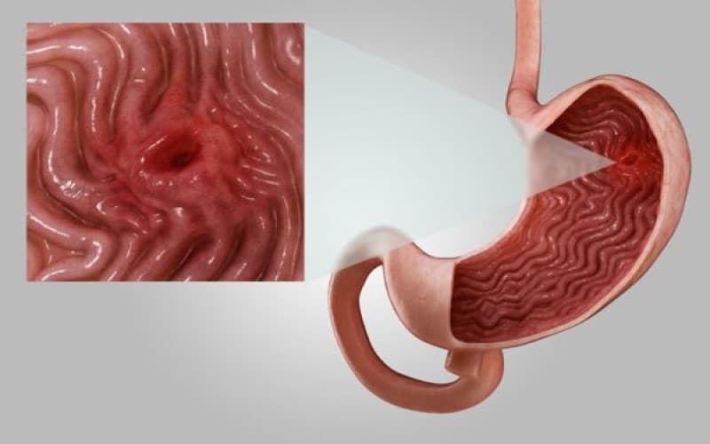 Niêm mạc dạ dày bị tổn thương gây loét