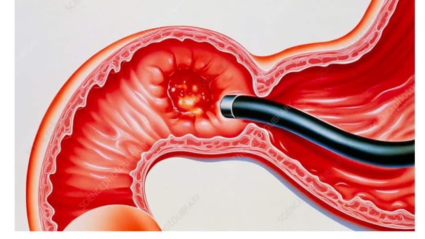 Viêm tá tràng là gì? Nguyên nhân, triệu chứng và điều trị như thế nào?
