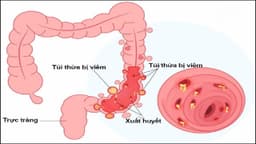 Viêm túi thừa đại tràng kiêng ăn gì để tránh làm nặng triệu chứng?
