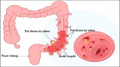Viêm túi thừa đại tràng kiêng ăn gì để tránh làm nặng triệu chứng?