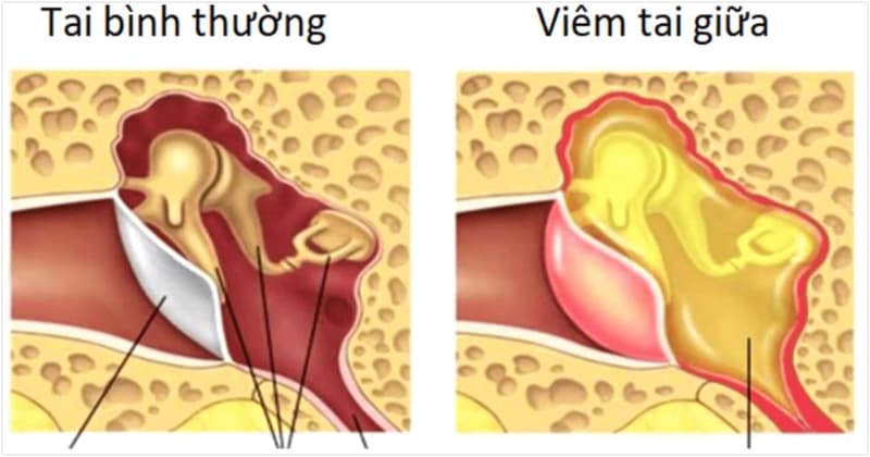 Cơ vòi hầu: Vai trò quan trọng trong sức khỏe tai và hô hấp