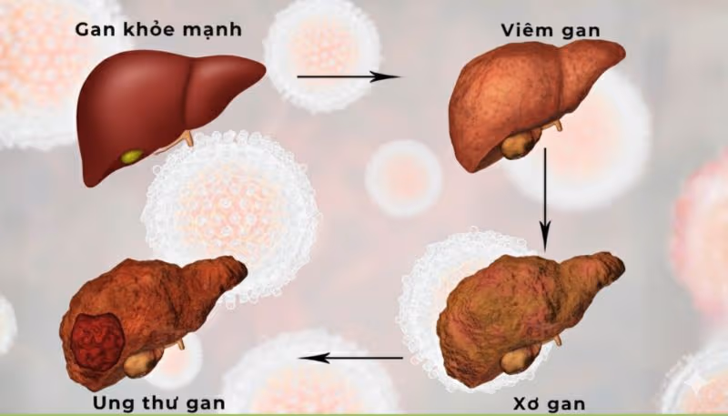 Kết quả xét nghiệm phát hiện xơ gan cần được đánh giá tổng thể, không nên dựa vào một chỉ số riêng lẻ