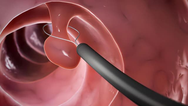 Có sao không khi xoắn polyp cổ tử cung bị chảy máu và cách xử lý