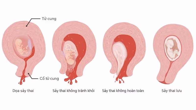 Sảy thai là tình trạng mất thai tự nhiên trước tuần thứ 20 của thai kỳ, thường liên quan đến bất thường nhiễm sắc thể.