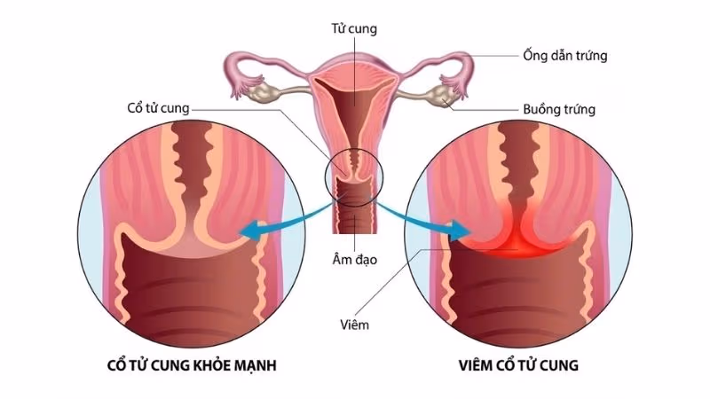 Viêm cổ tử cung là tình trạng cổ tử cung bị sưng viêm, có thể diễn tiến cấp tính hoặc mạn tính.