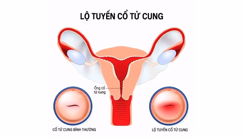Viêm lộ tuyến cổ tử cung có thể gây tăng tiết khí hư, chảy máu bất thường và đau khi quan hệ.