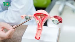 Polyp cổ tử cung: Khi nào cần theo dõi và nên điều trị?