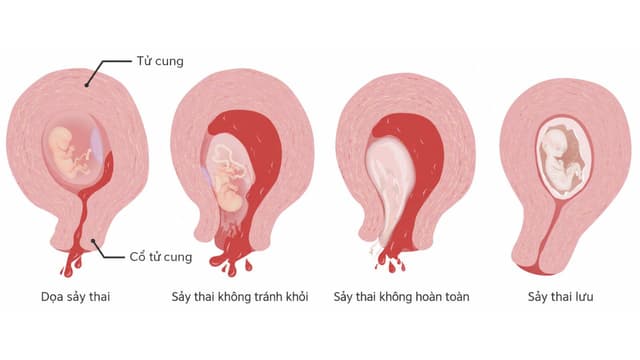 Hiện tượng sảy thai là gì và những điều cần biết?