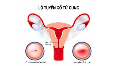 Viêm lộ tuyến cổ tử cung là gì? Có nguy hiểm hay không?