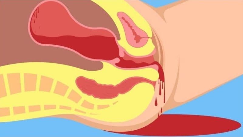 Sảy thai có thể gây băng huyết, nhiễm trùng, dính buồng tử cung và ảnh hưởng đến sức khỏe sinh sản.