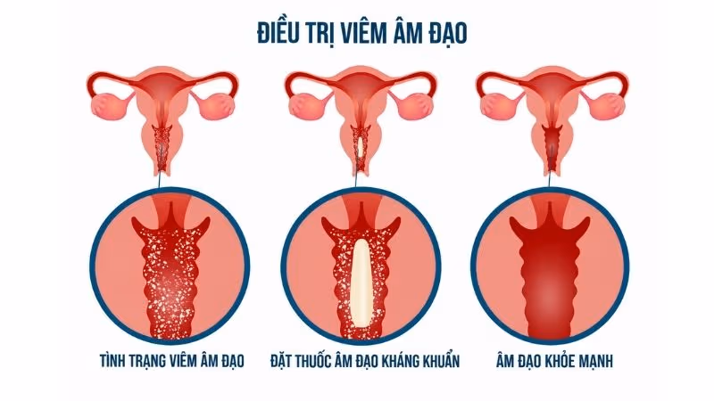 Điều trị viêm âm đạo cần dựa vào đúng nguyên nhân gây bệnh.