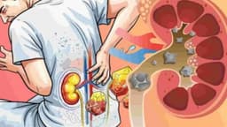 Sỏi thận 6mm có được xem là sỏi lớn không? Nên theo dõi hay điều trị?