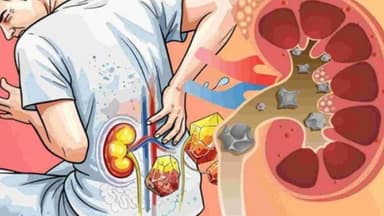 Sỏi thận 6mm có được xem là sỏi lớn không? Nên theo dõi hay điều trị?